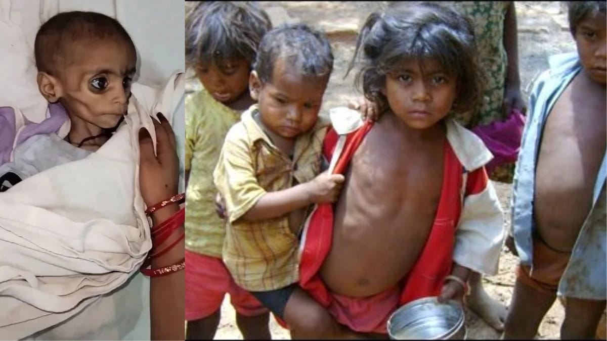 आठ रुपये में कैसे मिटेगा कुपोषण ? MP में 8 साल से नहीं बढ़ी आंगनबाड़ी पोषण दर, 33% बच्चे अभी भी कम वजन के शिकार